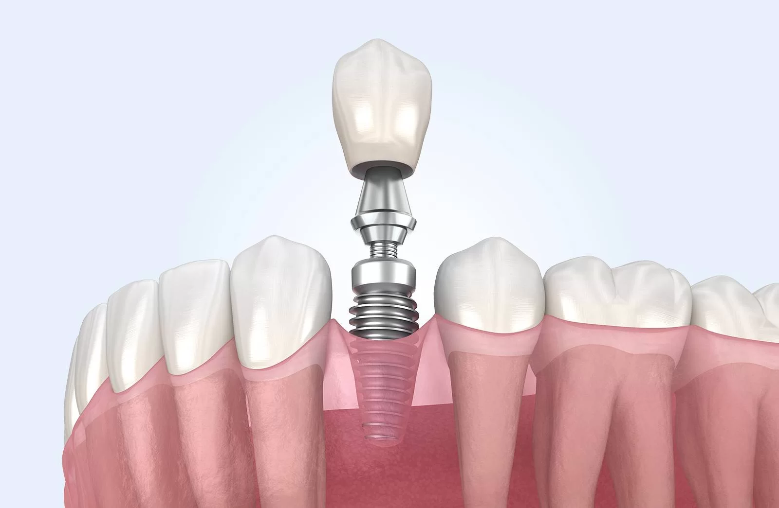 Dantų implantacija „Viskas įskaičiuota”