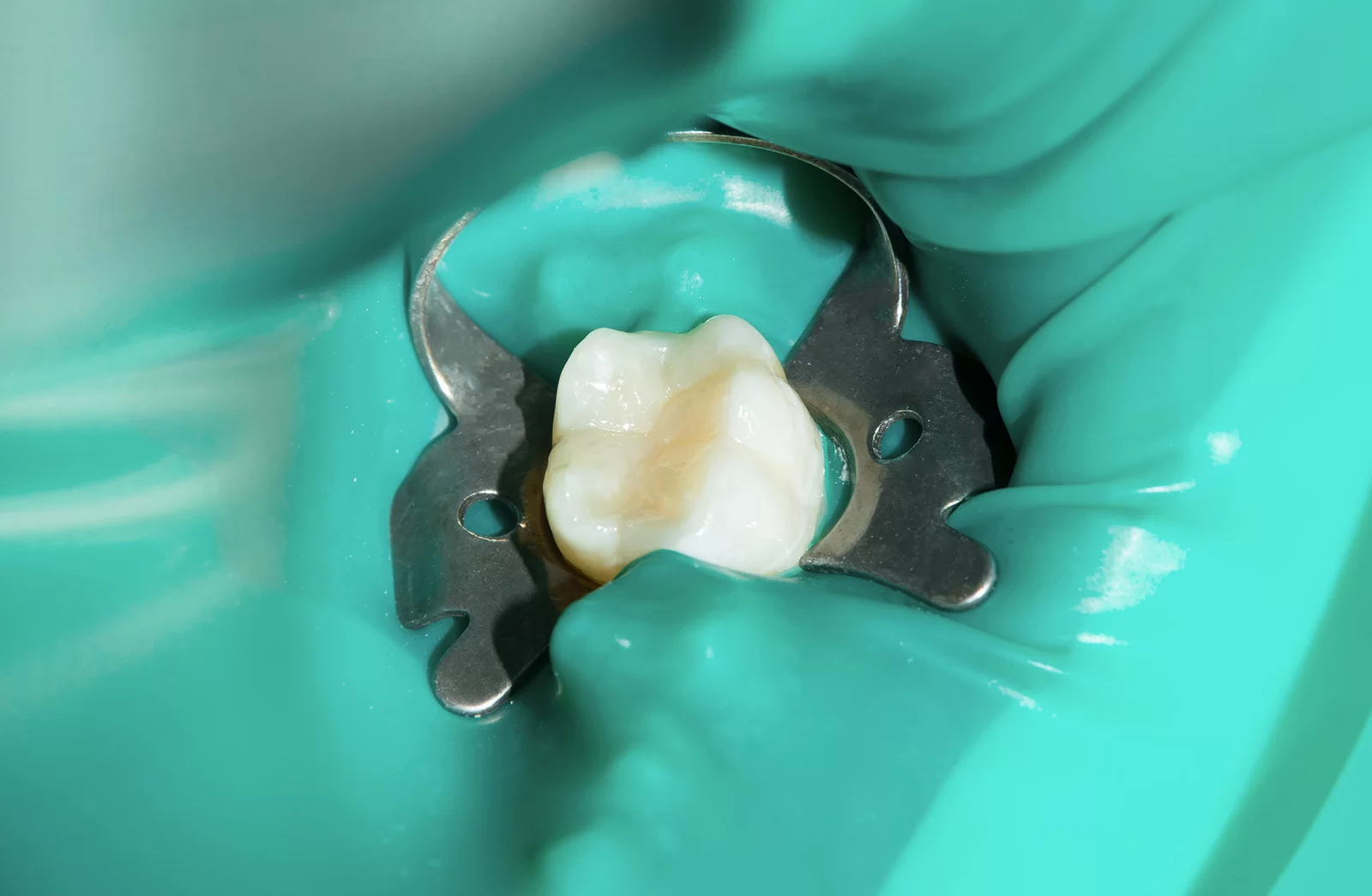 Zobu kanālu ārstēšana (endodontija)