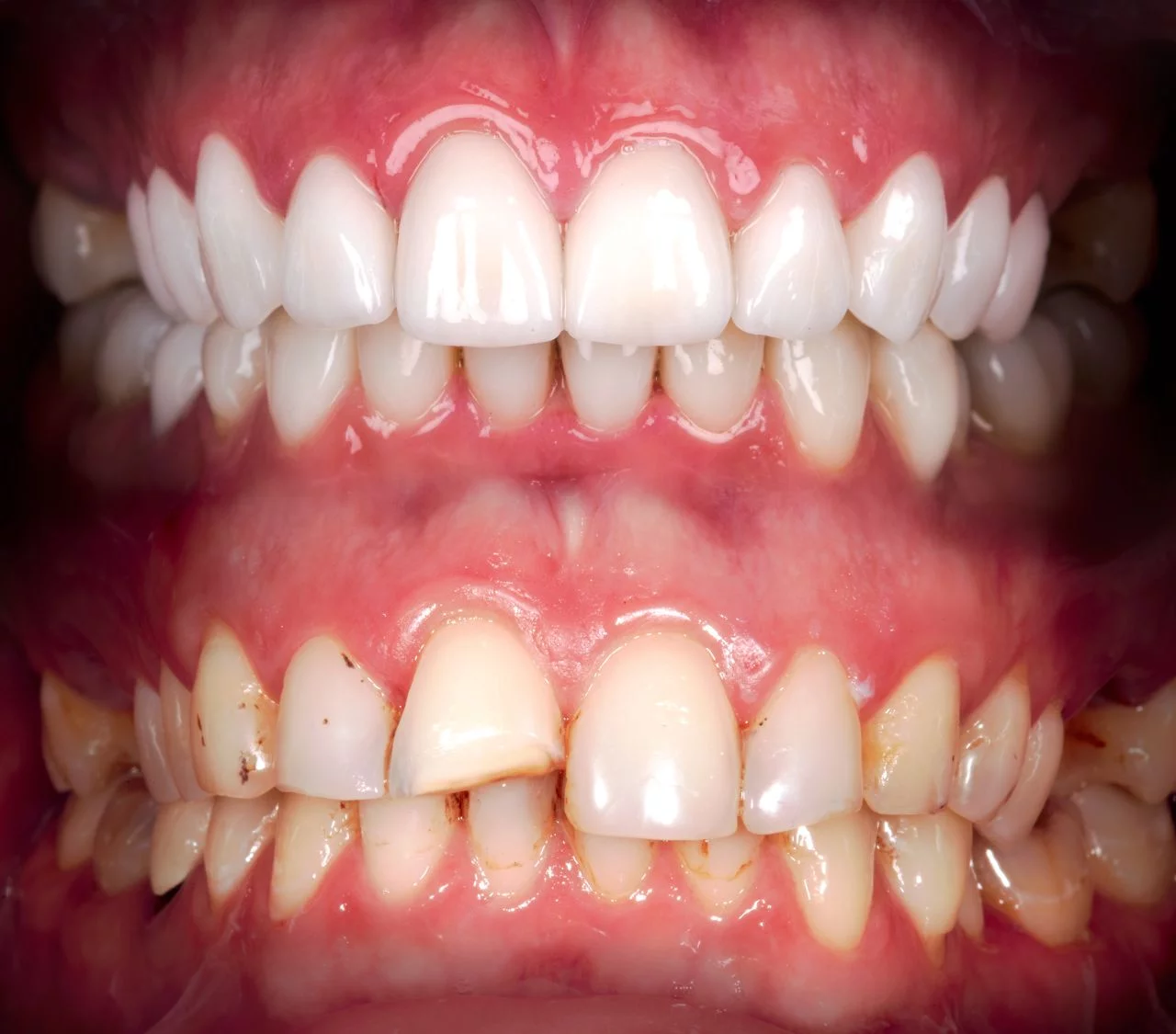 Aesthetic fillings