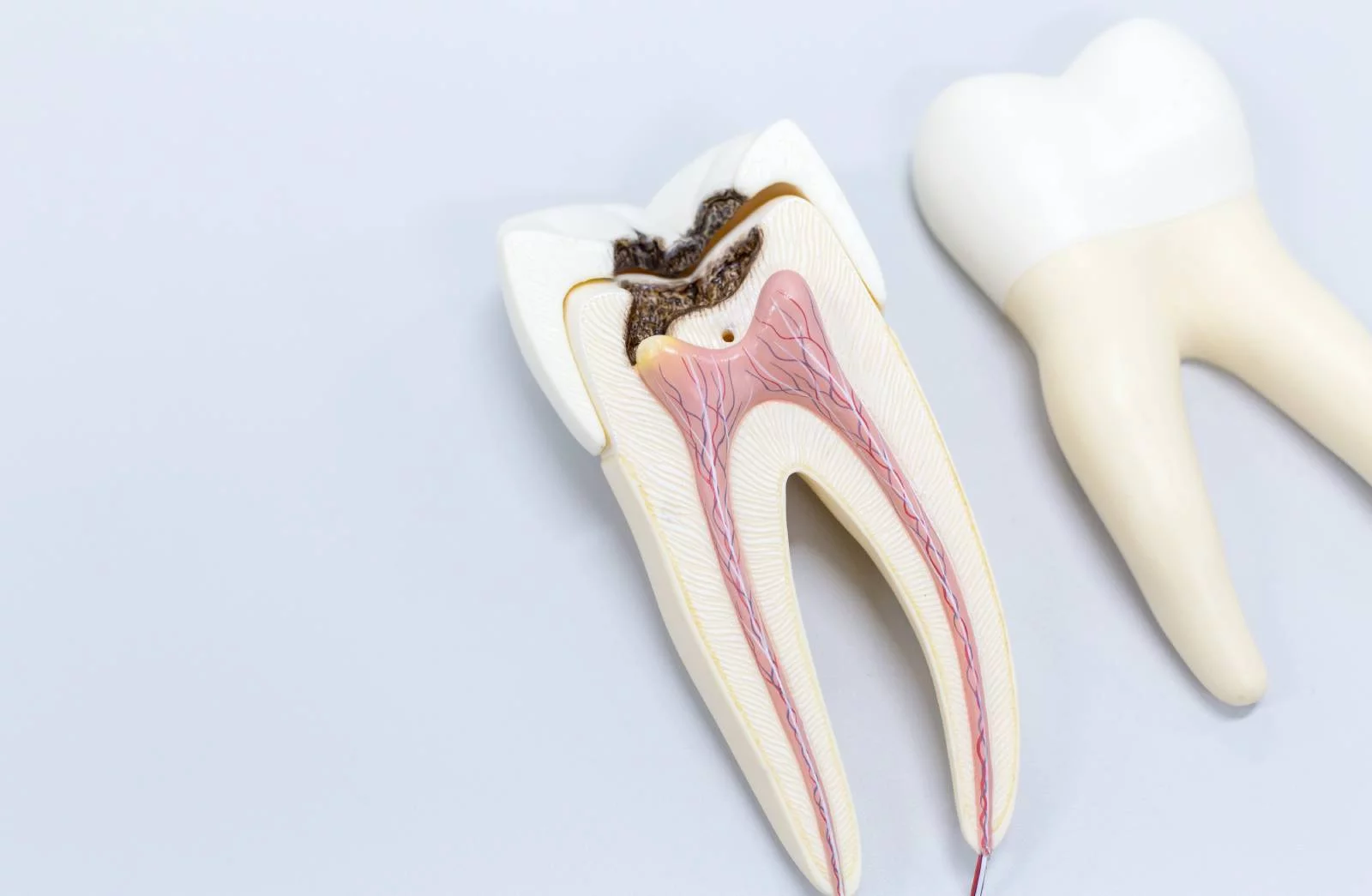 Zobu kanālu ārstēšana (endodontija)