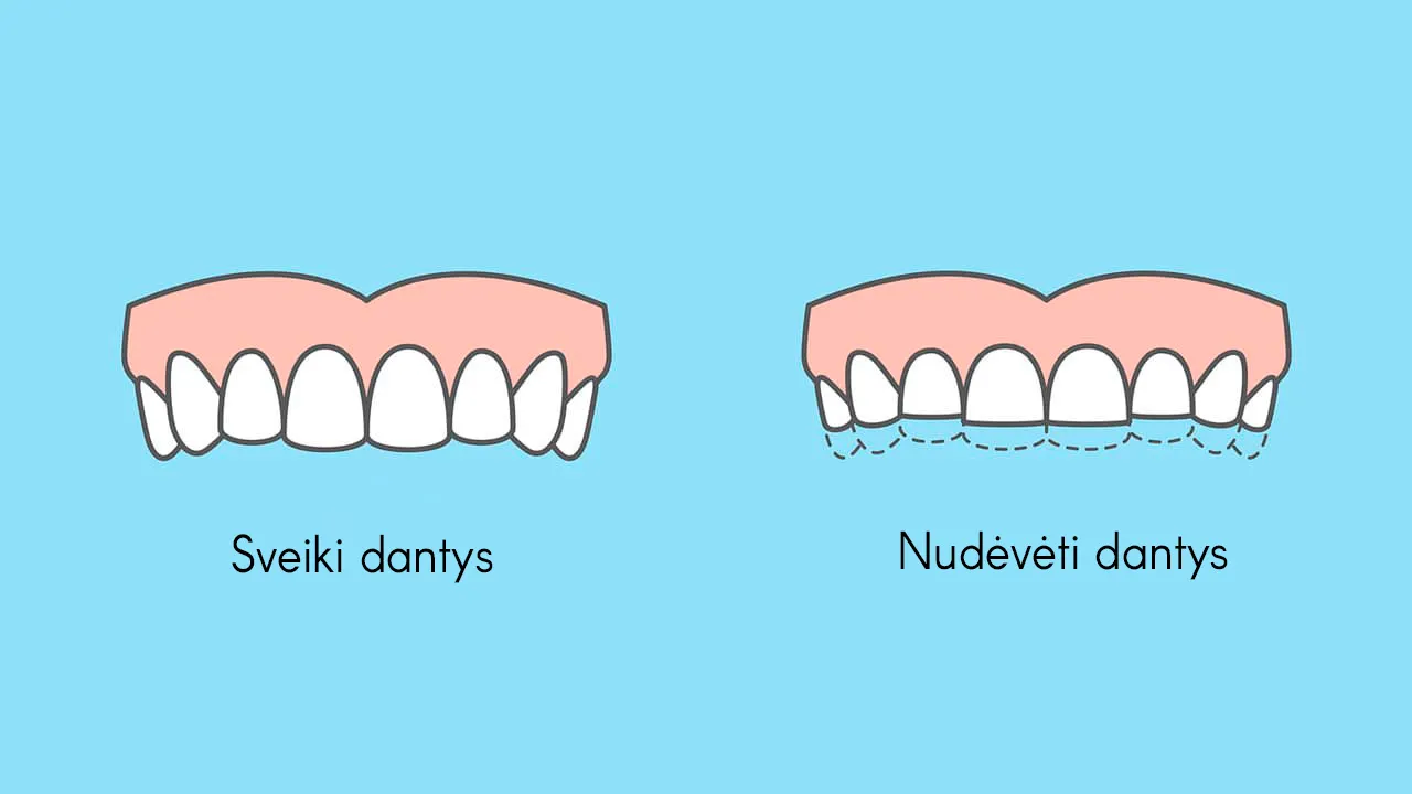 Bruksizmo požymiai:
