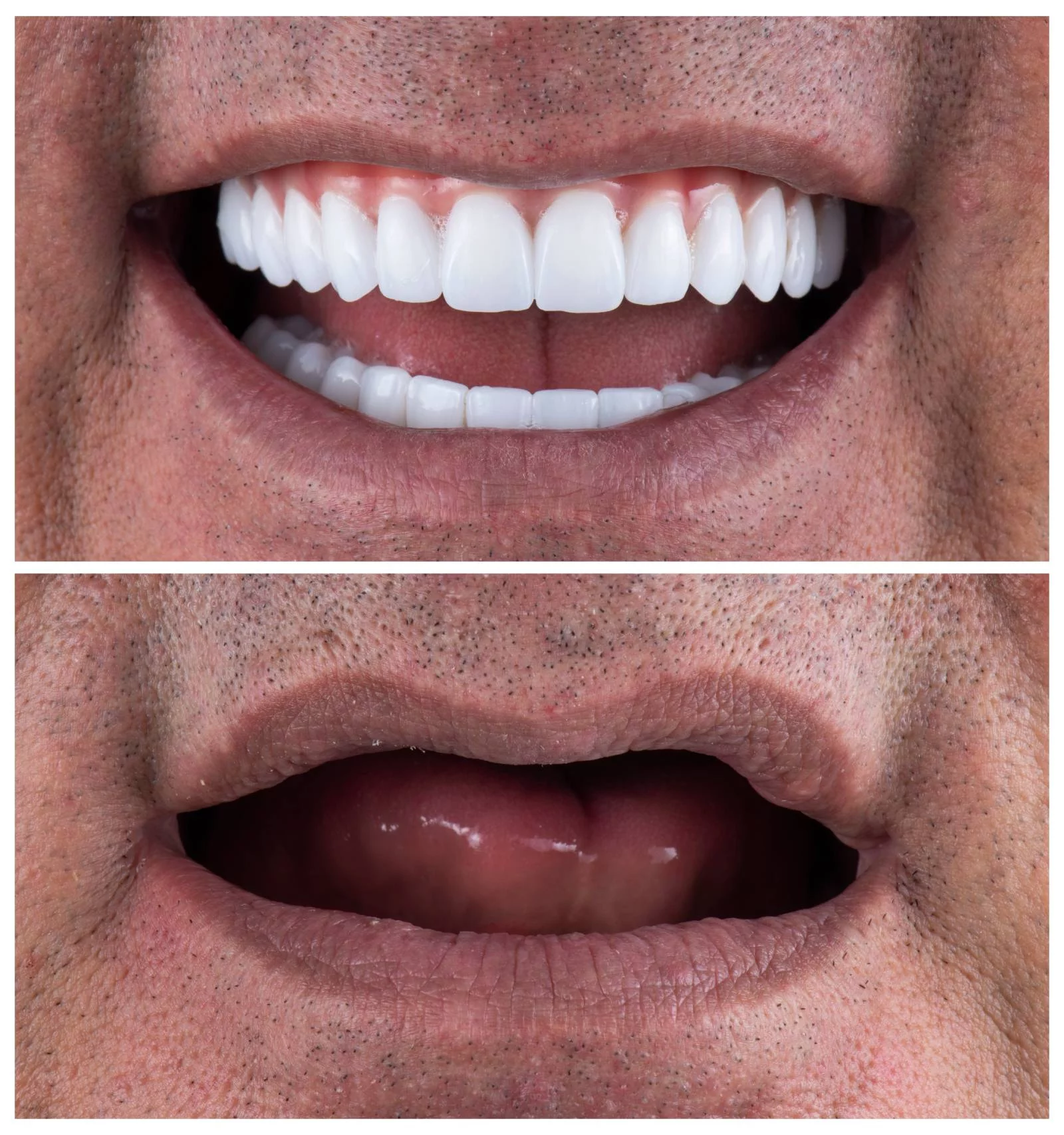 Restoration of the edentulous jaw with implants