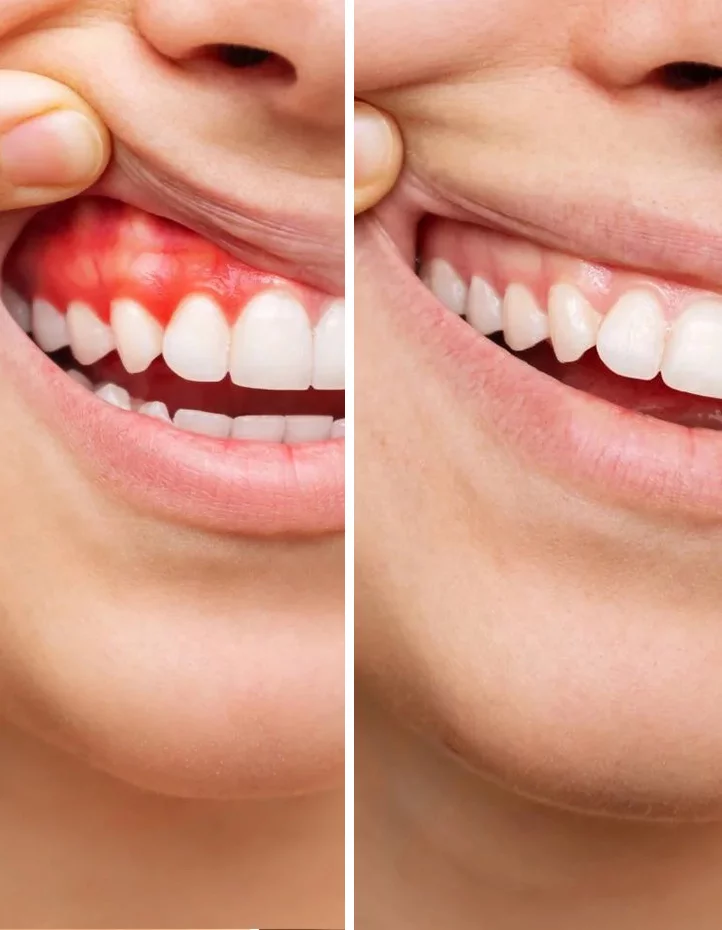 Periodontoloģija, smaganu atkāpšanās ārstēšana