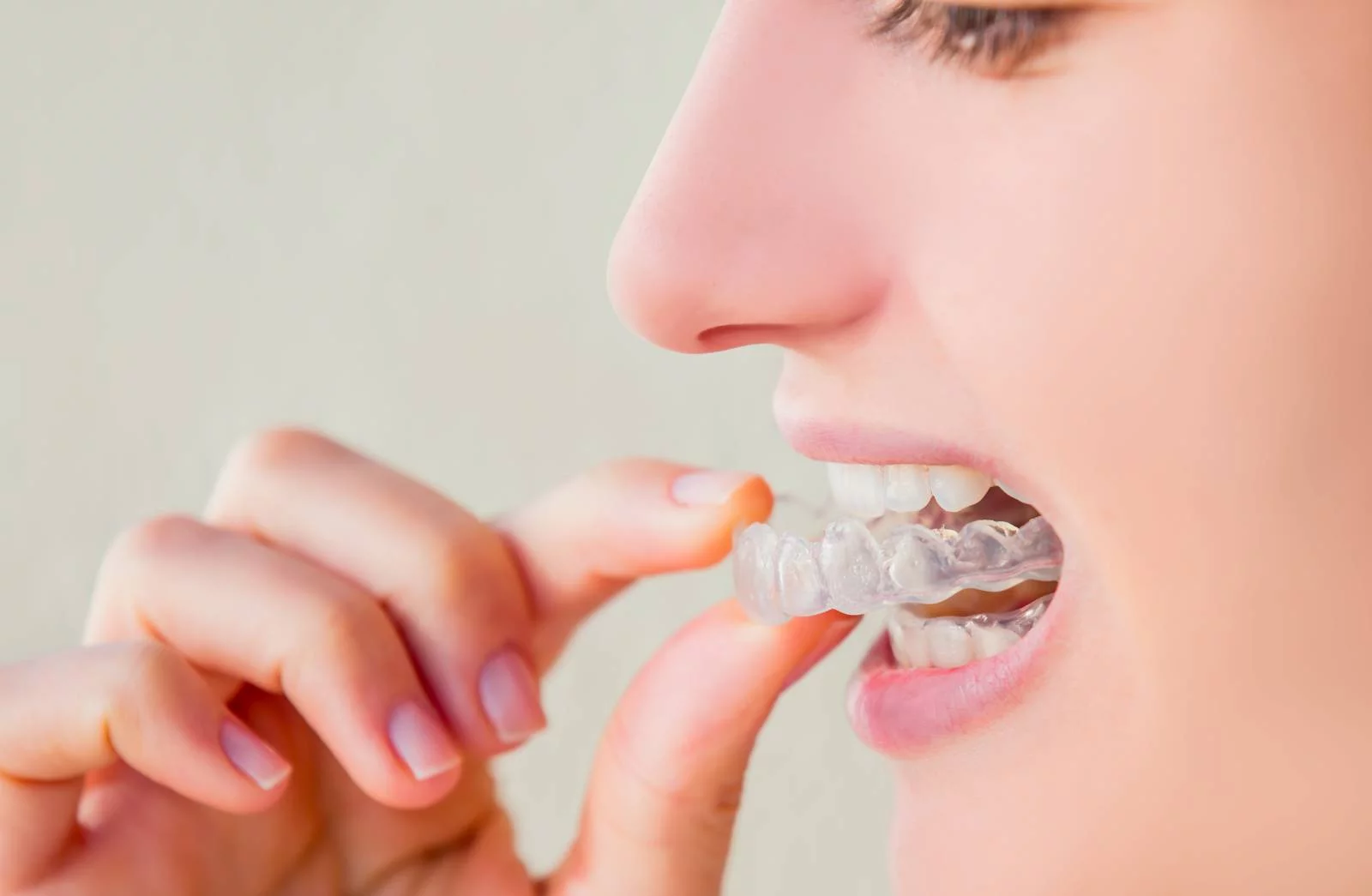 Invisible dental straightening aligners