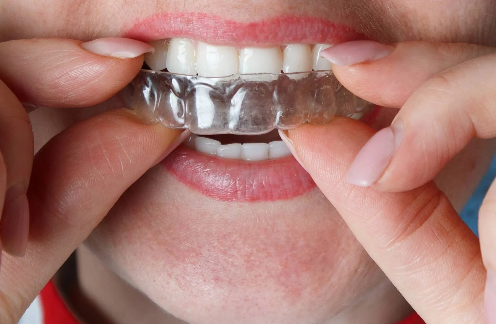 Invisible dental straightening aligners